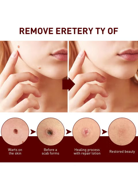 Jaysuing Liquid Wart Flat – Advanced Wart Remover for Face, Hands & Body (20ml)