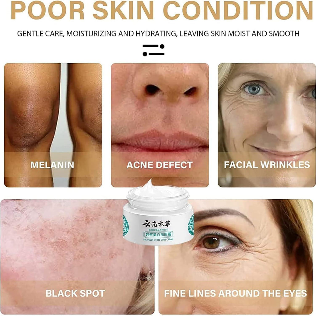 Japanese Melasma & Dark Spot Removal Cream – Dr. Hancy & Hoshi Whitening Herbal Formula (Yunnan Freckle Treatment)