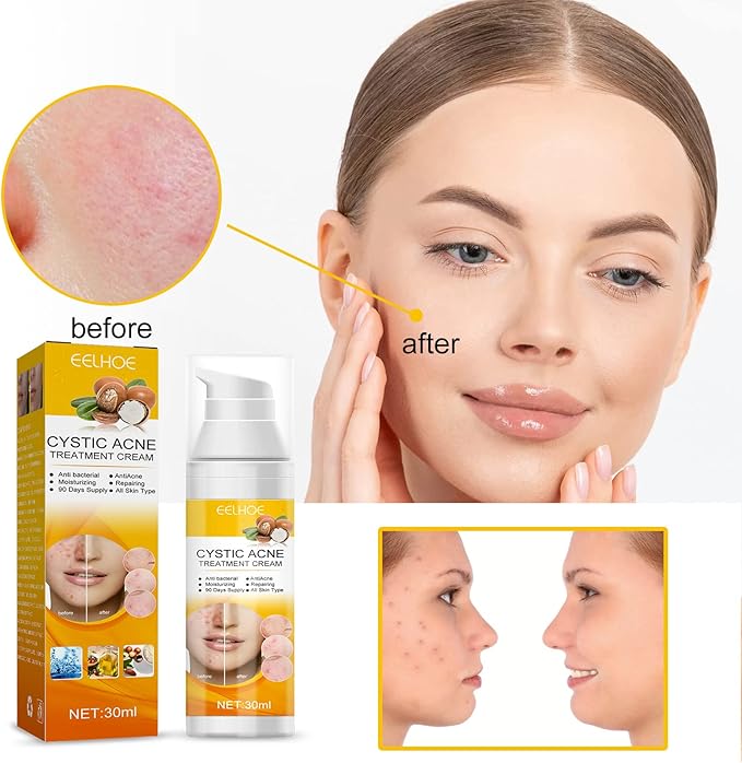 EELHOE Cystic Acne Treatment Cream – Anti-Acne, Hydrating & Moisturizing Formula for Clear, Smooth Skin (30ml)