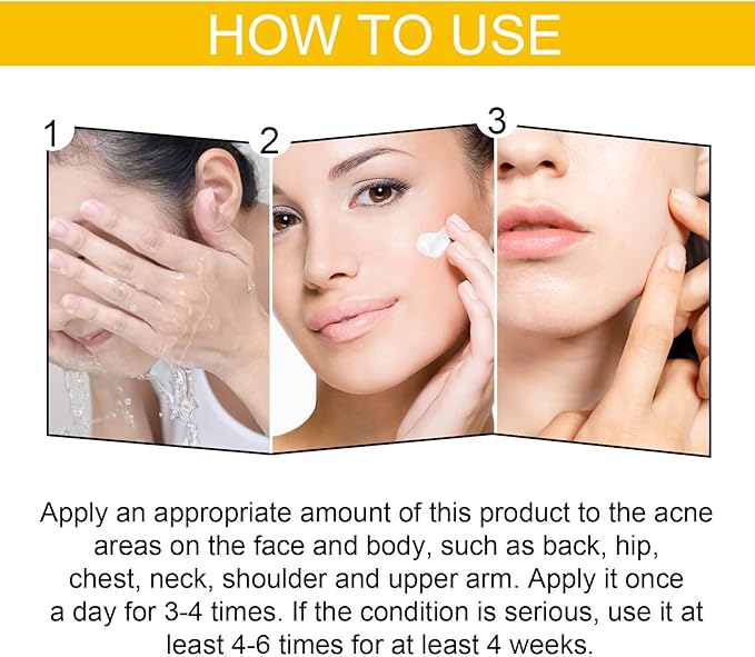EELHOE Cystic Acne Treatment Cream – Anti-Acne, Hydrating & Moisturizing Formula for Clear, Smooth Skin (30ml)