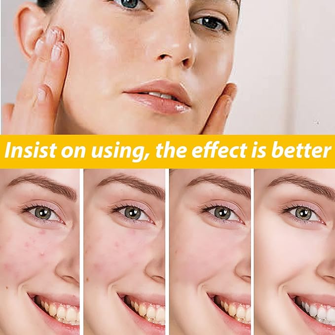 EELHOE Cystic Acne Treatment Cream – Anti-Acne, Hydrating & Moisturizing Formula for Clear, Smooth Skin (30ml)