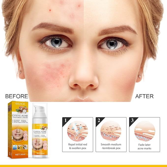 EELHOE Cystic Acne Treatment Cream – Anti-Acne, Hydrating & Moisturizing Formula for Clear, Smooth Skin (30ml)